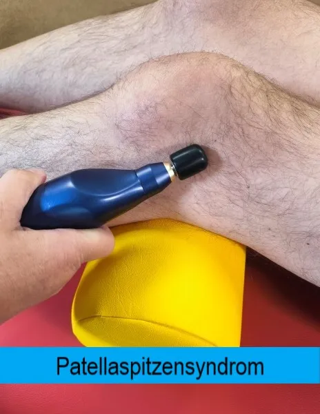 Secona - BMS Activ Patellaspitzensyndrom